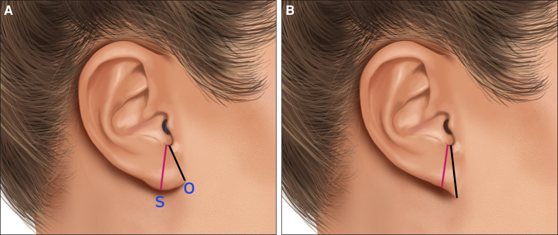 耳廓部分旋转在亚洲人除皱术中预防与矫正 pixie ear 畸形的临床观察